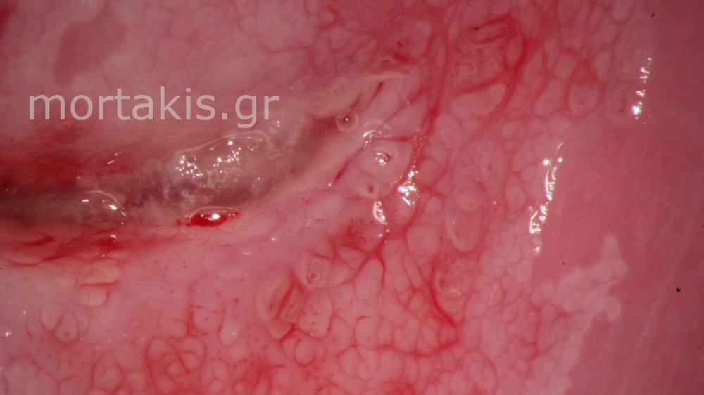 CERVICAL VESSELS - Αγγεία Τραχήλου Μήτρας