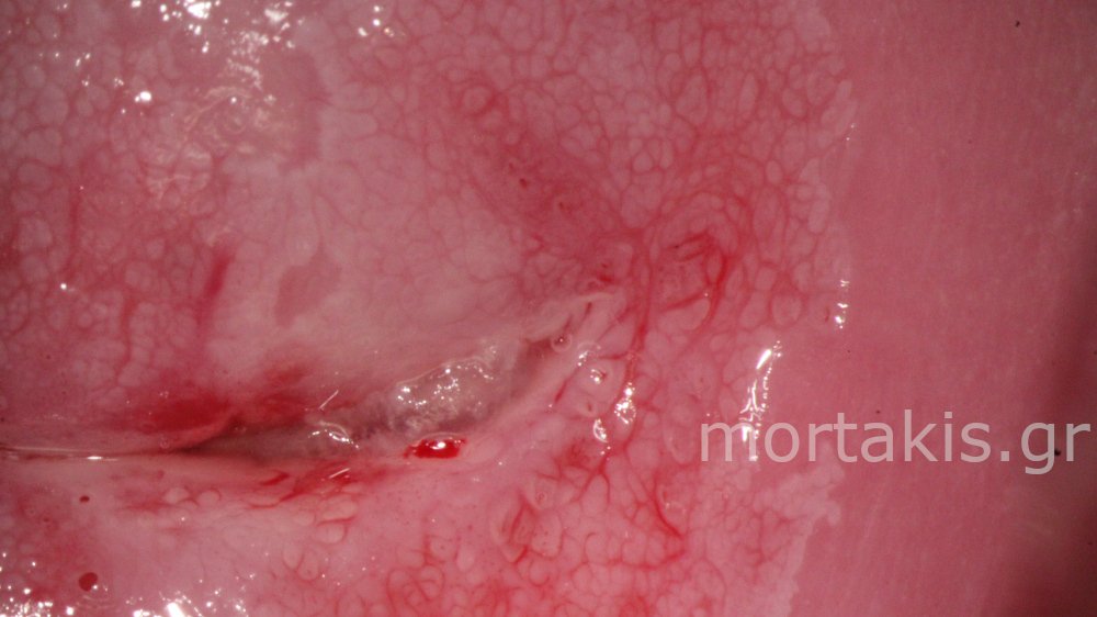 CERVICAL VESSELS - Αγγεία Τραχήλου Μήτρας