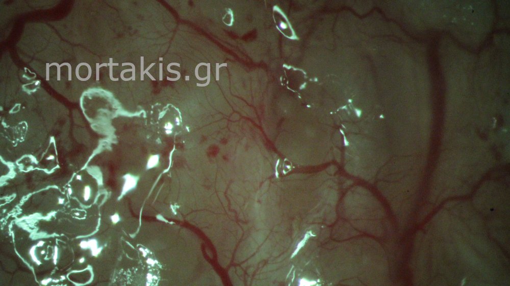 CERVICAL VESSELS - Αγγεία Τραχήλου Μήτρας