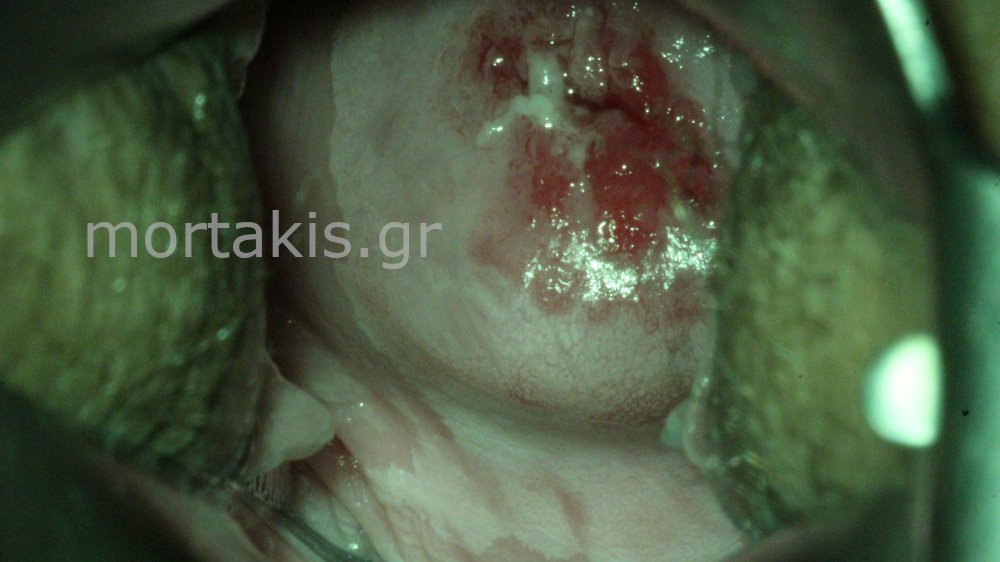 CONGENITAL TRANSFORMATION ZONE - Συγγενής ζώνη μετάπλασης