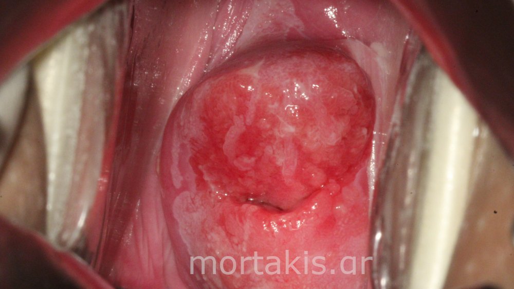 CONGENITAL TRANSFORMATION ZONE - Συγγενής ζώνη μετάπλασης