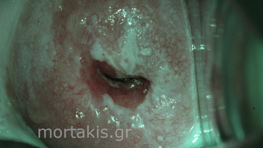 HSIL OF CERVIX - Υψηλού βαθμού αλλοιώσεις τραχήλου