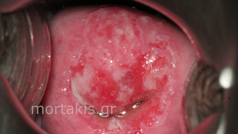 HSIL OF CERVIX - Υψηλού βαθμού αλλοιώσεις τραχήλου