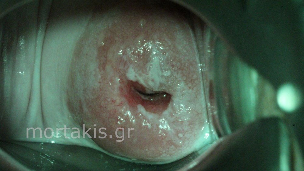 HSIL OF CERVIX - Υψηλού βαθμού αλλοιώσεις τραχήλου