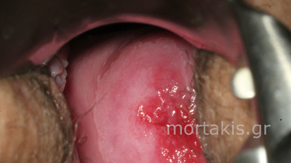 METAPLASIA CERVICAL - Μετάπλαση τραχήλου
