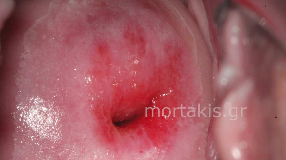 METAPLASIA CERVICAL - Μετάπλαση τραχήλου
